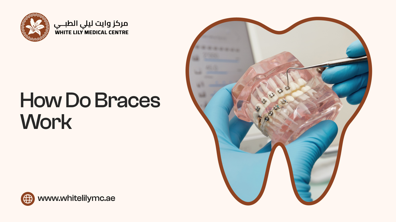 How Do Braces Work