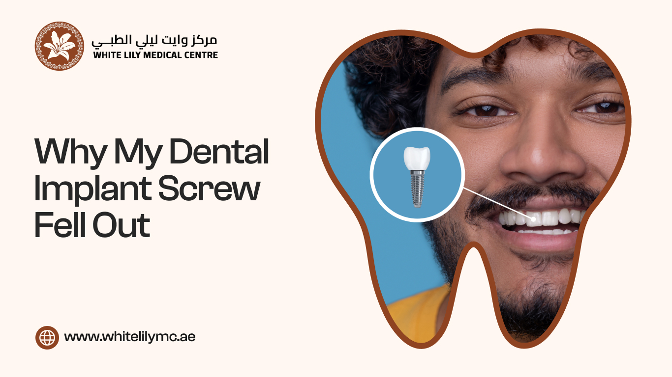 Why My Dental Implant Screw Fell Out