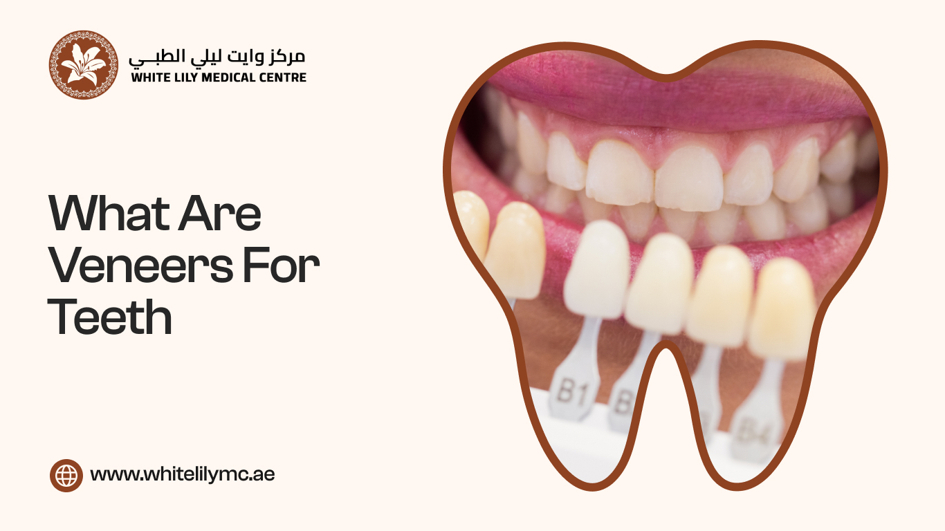 Veneers for Teeth
